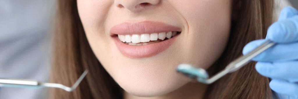 Lente de Contato Dental ou Faceta de Resina