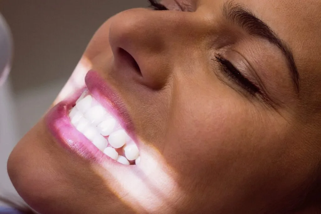 Lente de Contato Dental ou Faceta de Resina